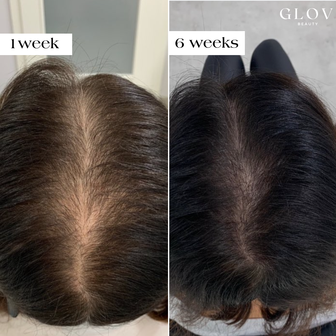 Glov Hair Regrowth System X