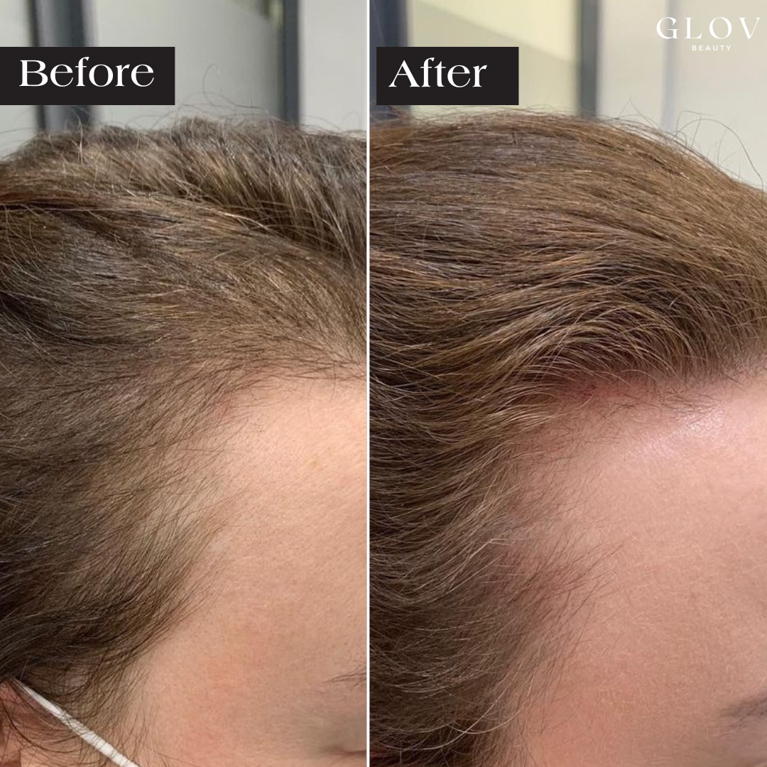 Glov Hair Regrowth System X