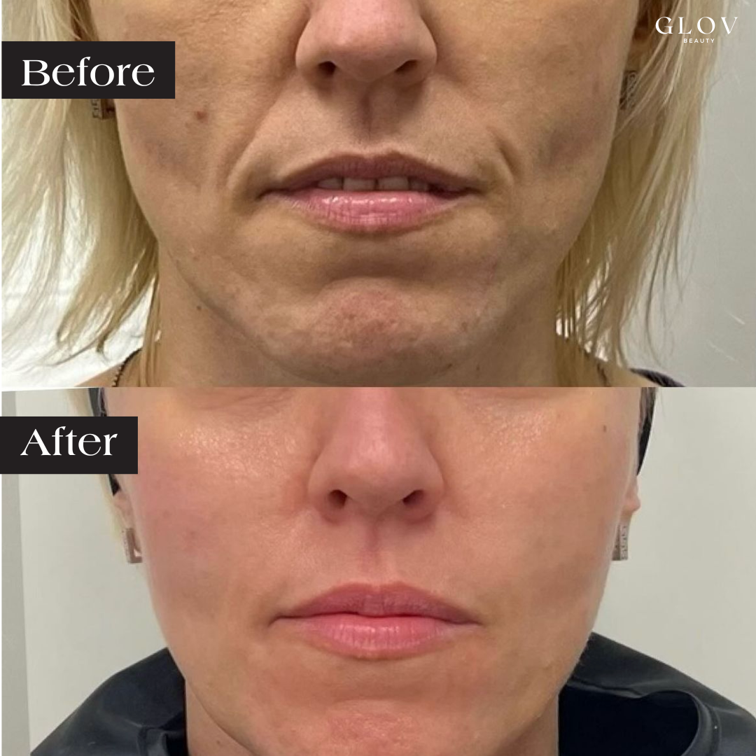 Glov LED Face Mask Anti-Aging Therapy - Glov Beauty