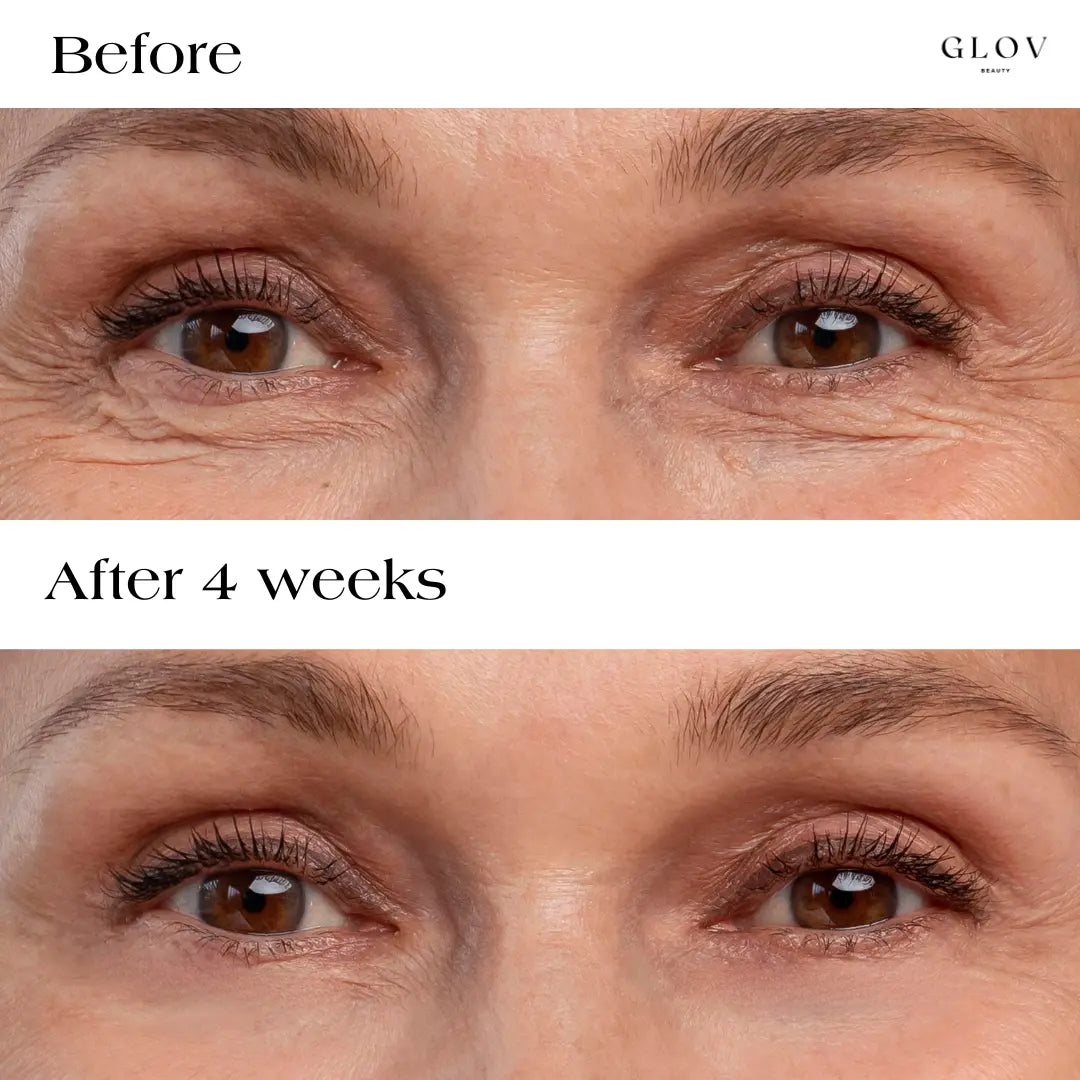 Glov Serum-Infused Microneedle Eye Patches - Glov Beauty
