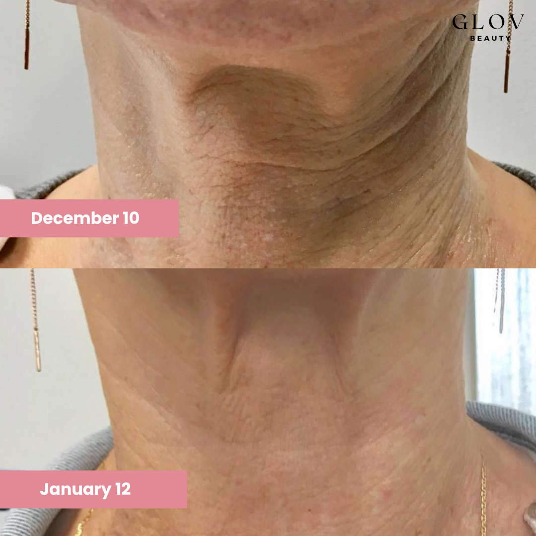 Crème Cou et Décolleté Glov – Lift & Fermeté